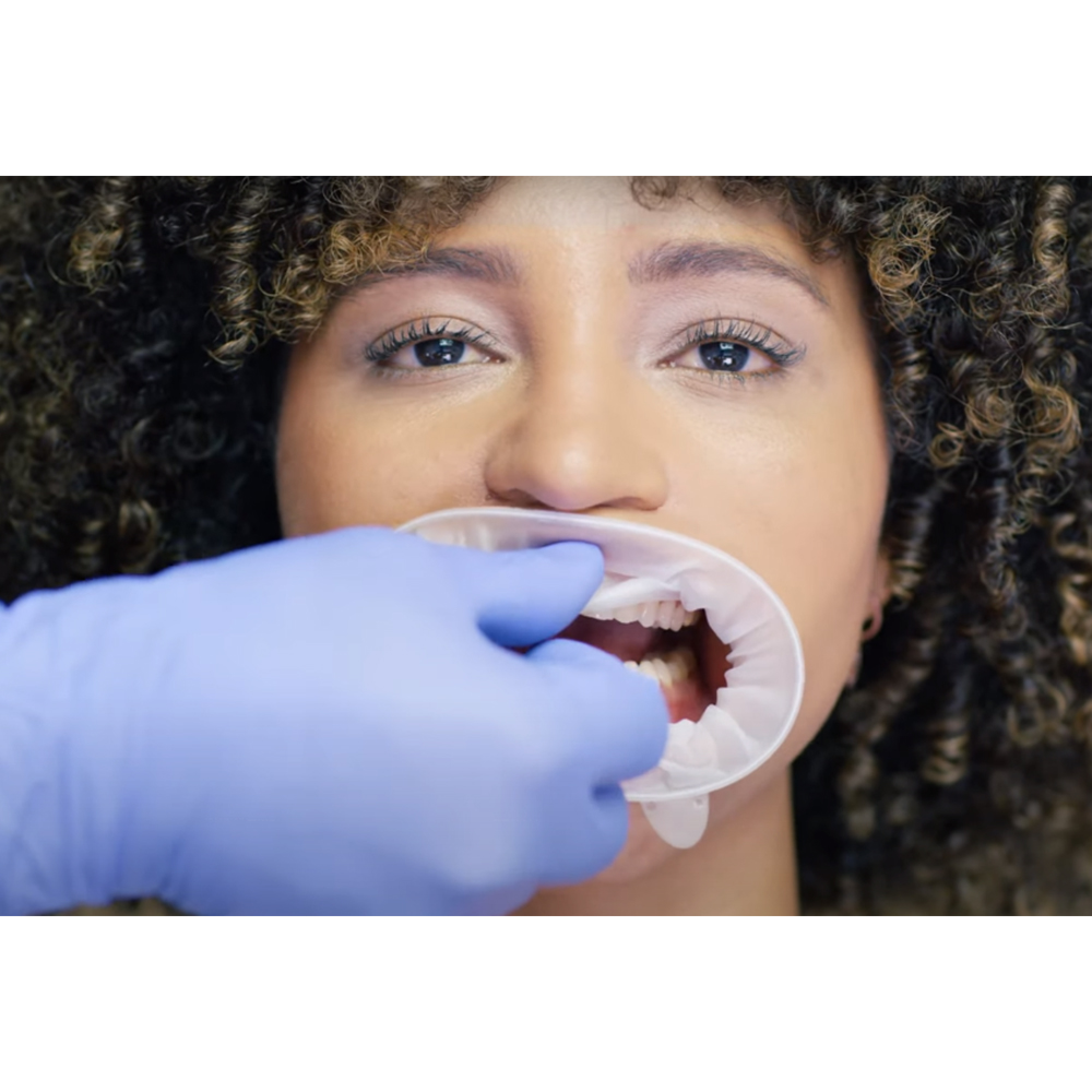 Ivoclar Optragate Cheek And Lip Retractor 