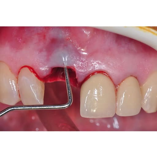 Oracraft Surgical Bone Curettes