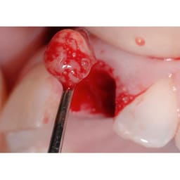 Oracraft Surgical Bone Curettes - 8