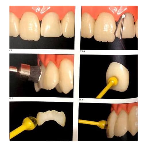 HN Dental Veneer Stick
