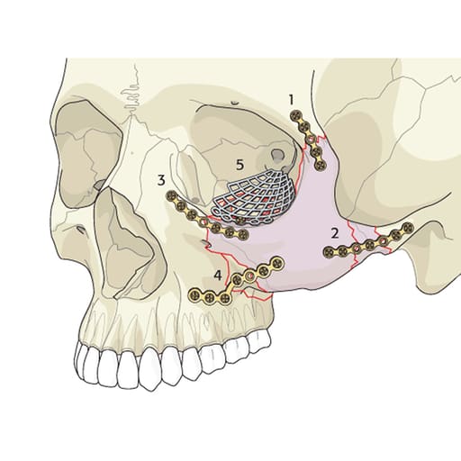 SK Surgicals SS Mini Bone Plates Orbital With Gap - 1.5mm (Pack of 2)