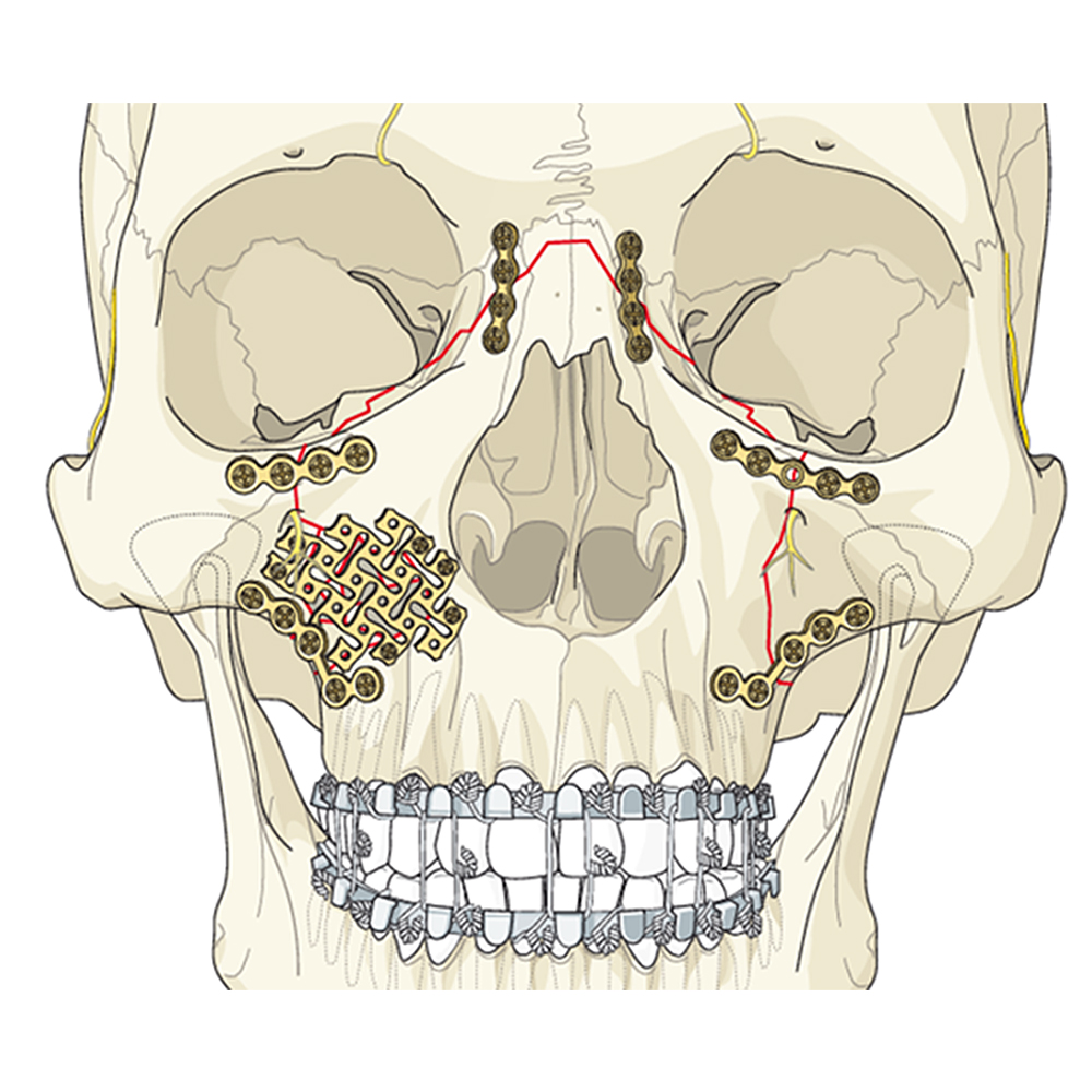SK Surgicals Titanium Mini Bone Plates Orbital Continuous - 1.5mm