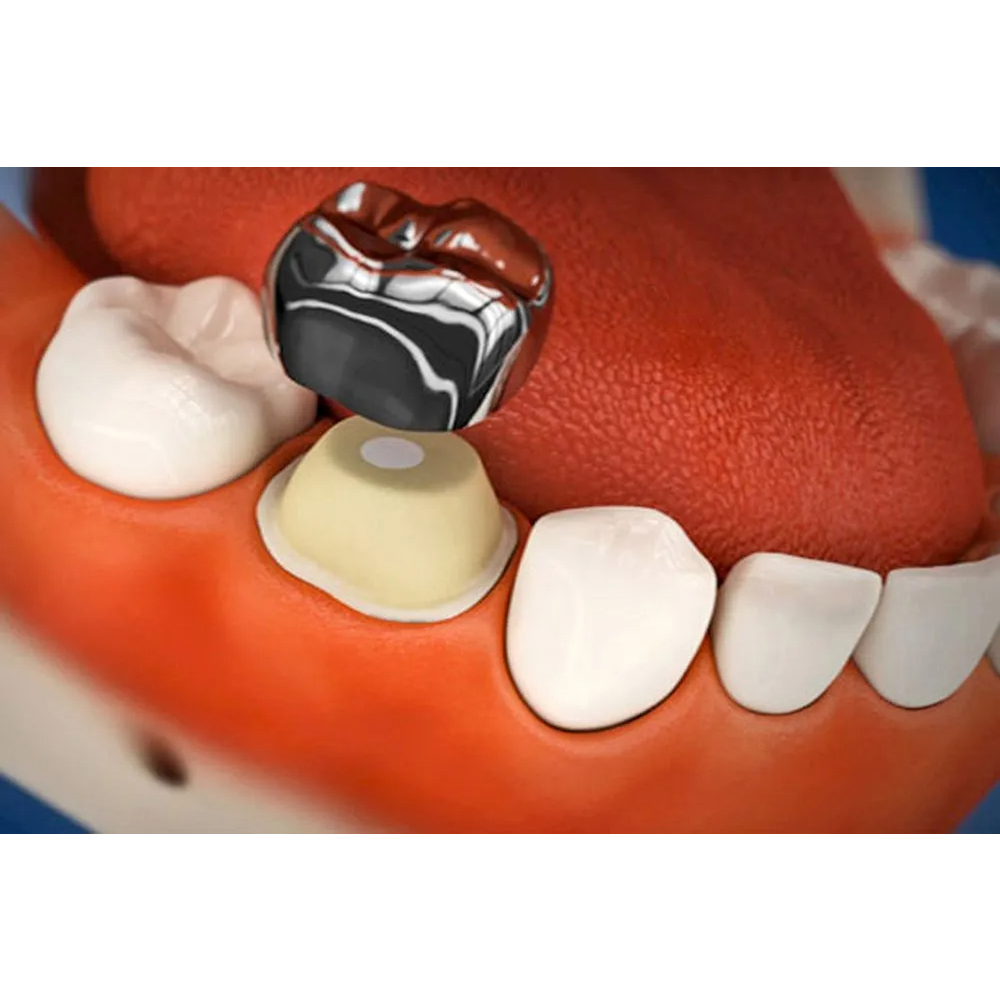 Oro SS Little Crown Primary Molar Kits