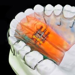 Konark Stainless Steel Orthodontic Wire - 13