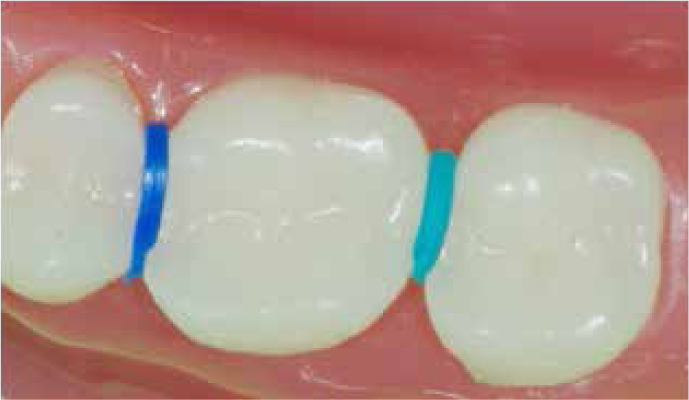 OrthoMetric Elastomerics Ring Separator (Pack of 1000)