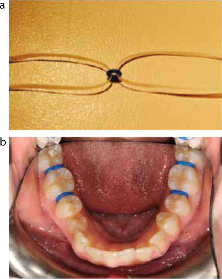 OrthoMetric Elastomerics Ring Separator (Pack of 1000)