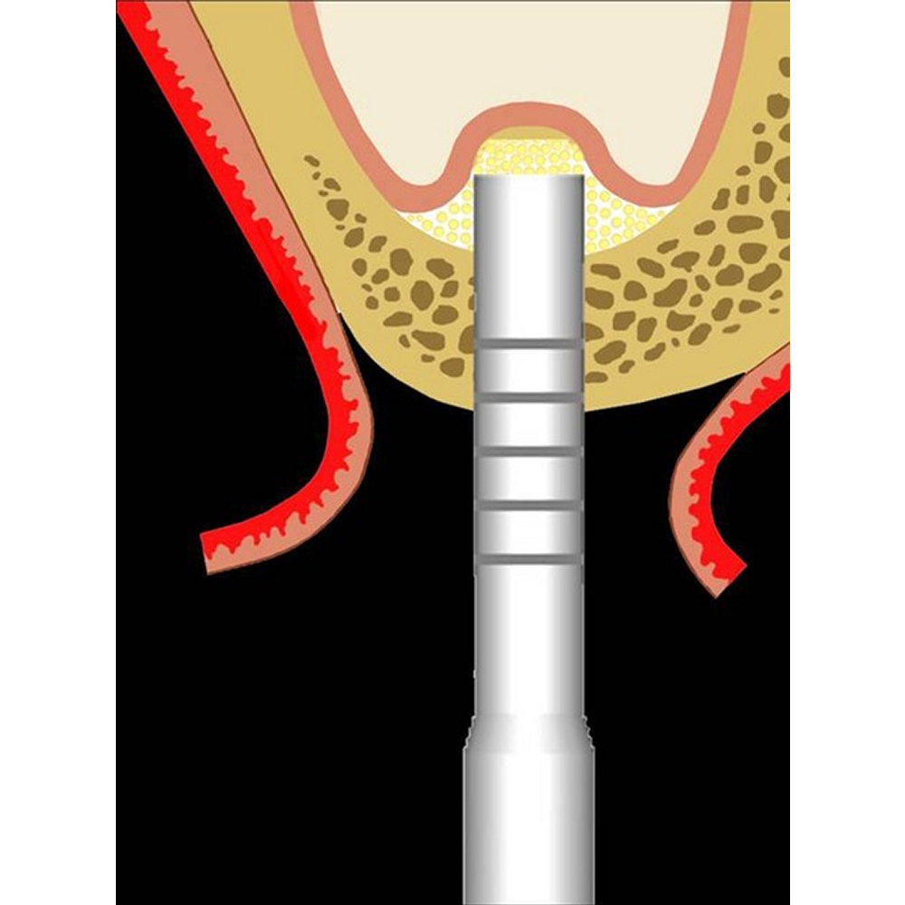 GDC Osteotomes Flat Curved with Cassette Set Of 6 (OSTMPUAWC6)