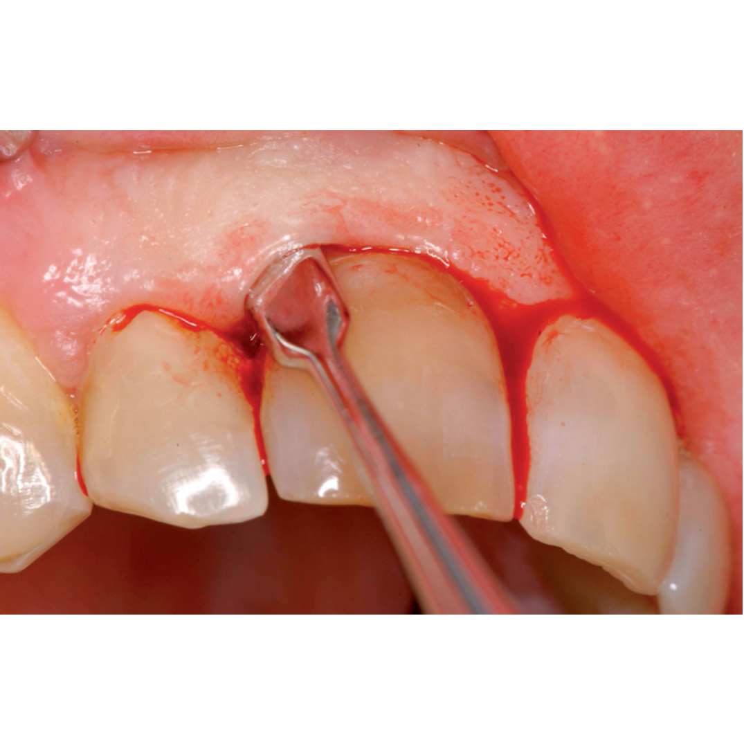 GDC Periosteal Elevator Hirschfeld - 6 (P20)