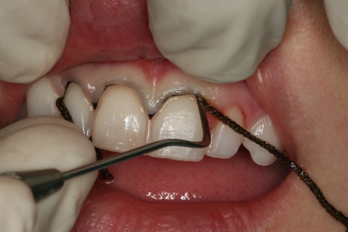 Ultradent Fischer's Ultrapak Packer 