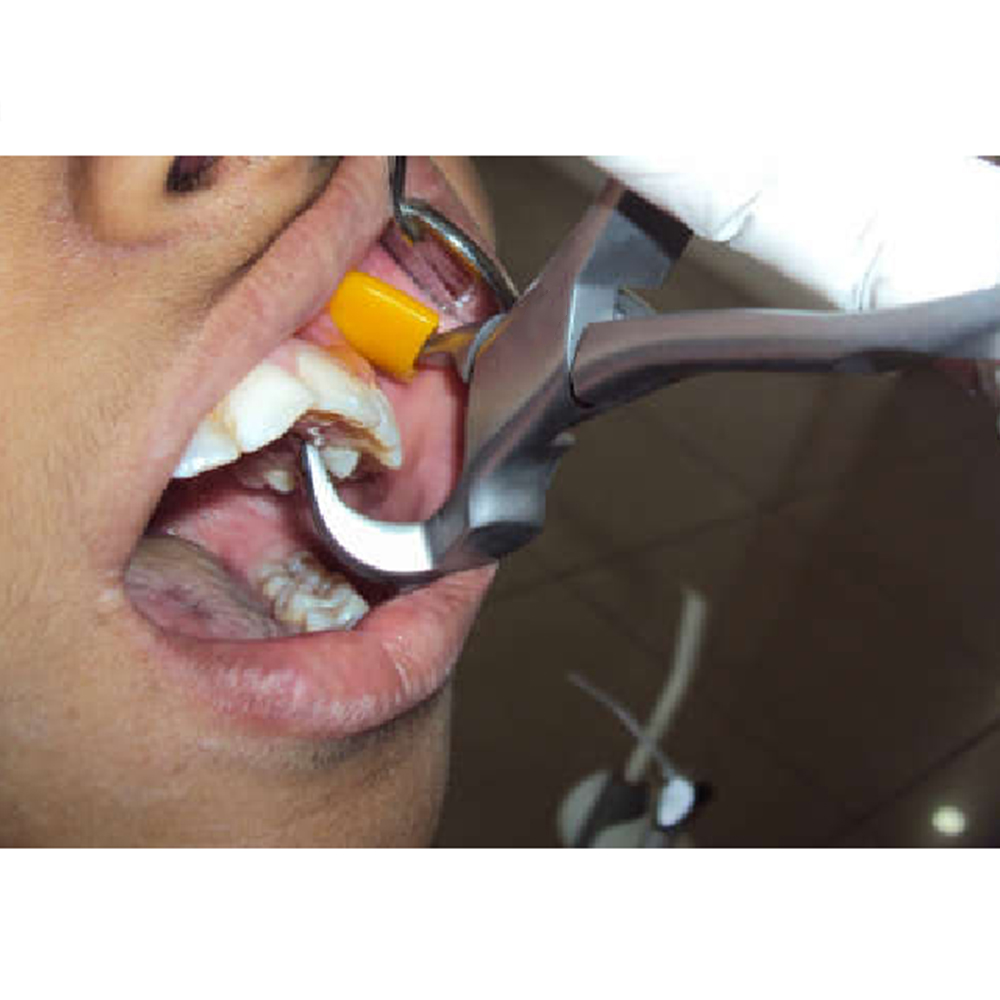 GDC Extraction Forceps Upper Left Physical (Pafx100ul)