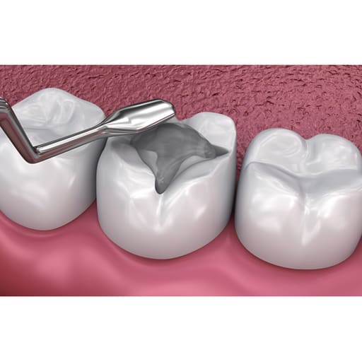 GDC Plastic Filling Instrument - 1 (PLGH3)