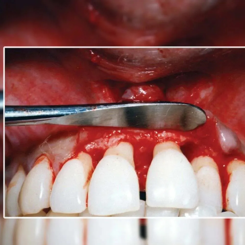 GDC Periosteal Elevator Freer (4mm/4mm) - 6 (P884)