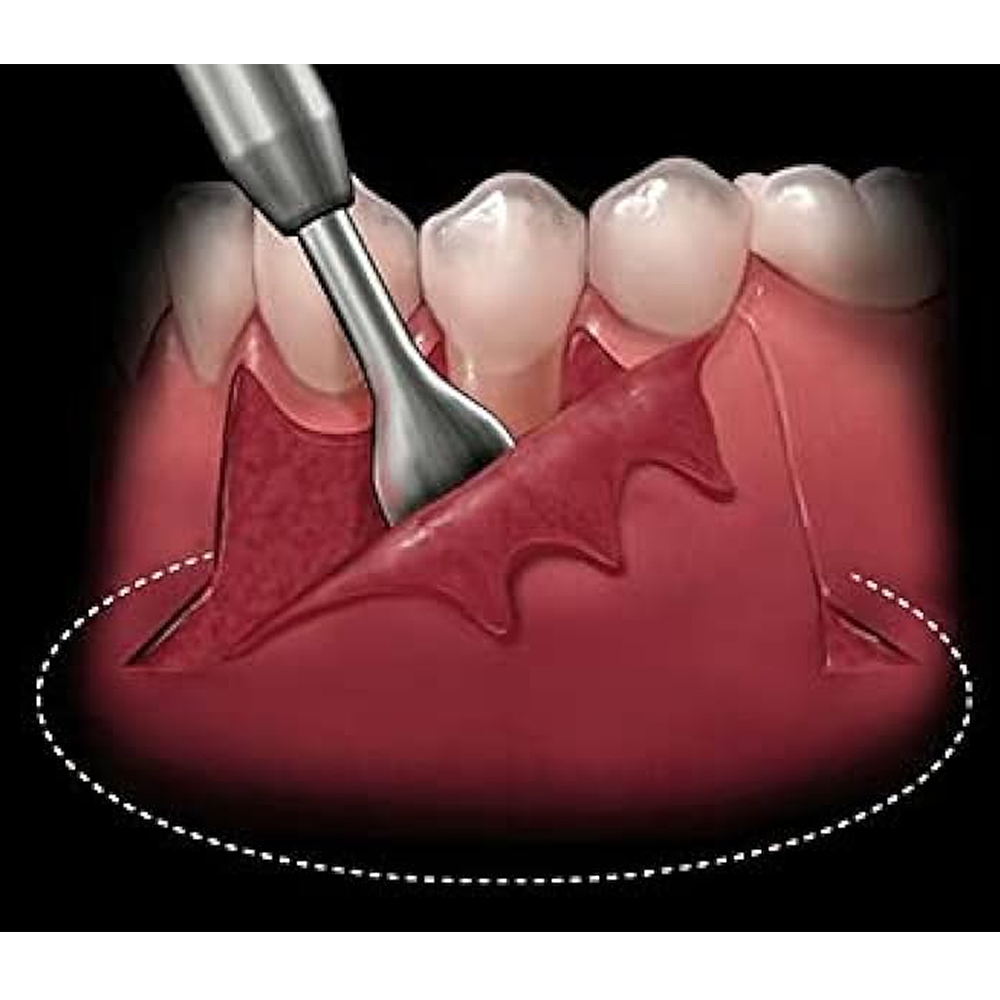 GDC Periosteal Elevator Benque - 6 (Pbq1)