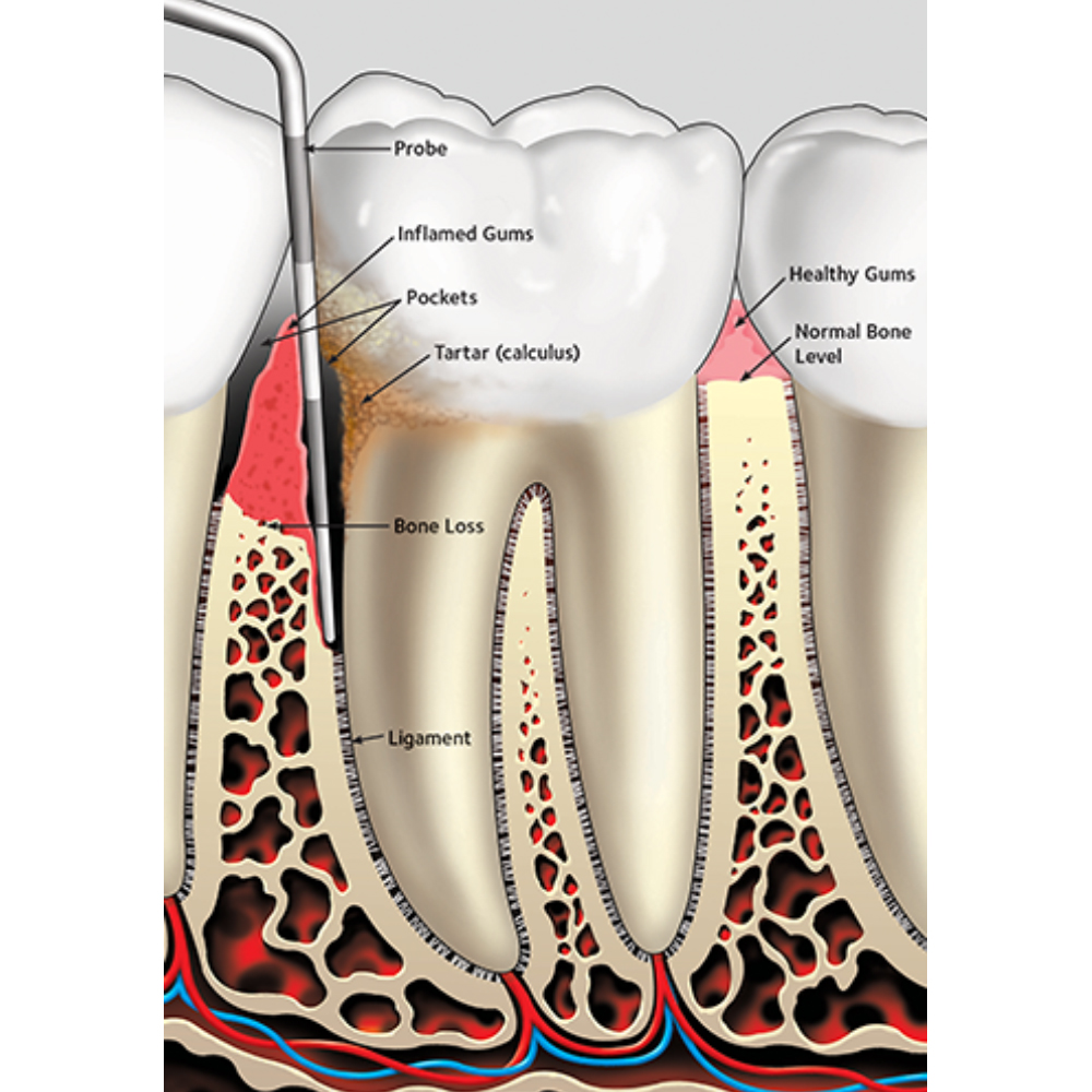GDC Single End Probes Marquis Color Coded #6 (Pcp12)