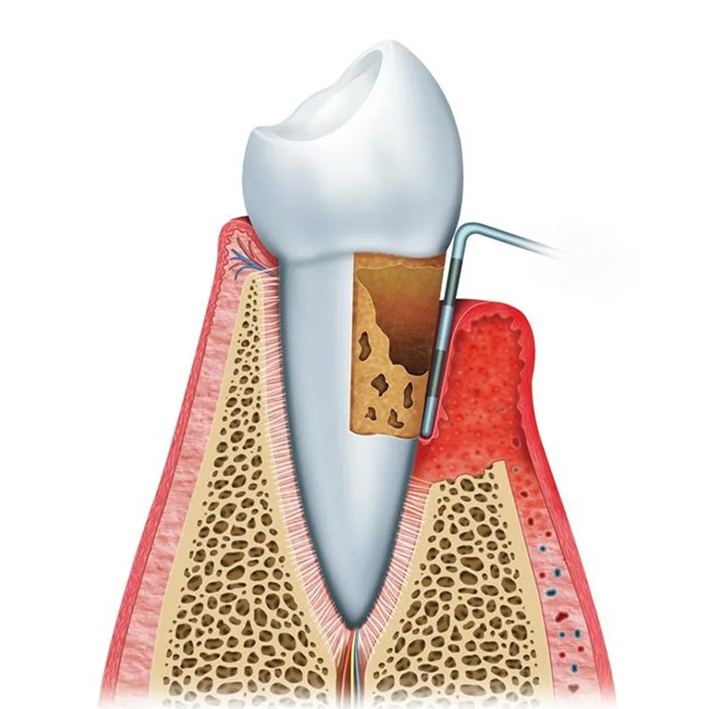 GDC Single End Probes Marquis Color Coded #6 (Pcp12)