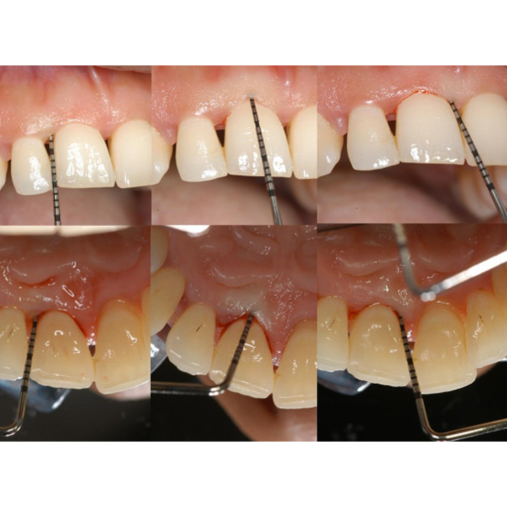 GDC Single End Probes University Of North Carolina #6 (Pcpunc15)