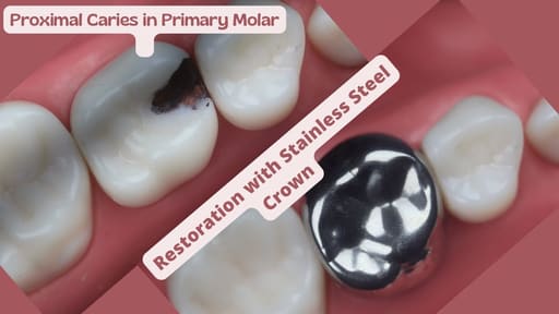 3M ESPE SS Crown Primary Molar Crown-D (1st molar) (Pack of 2)