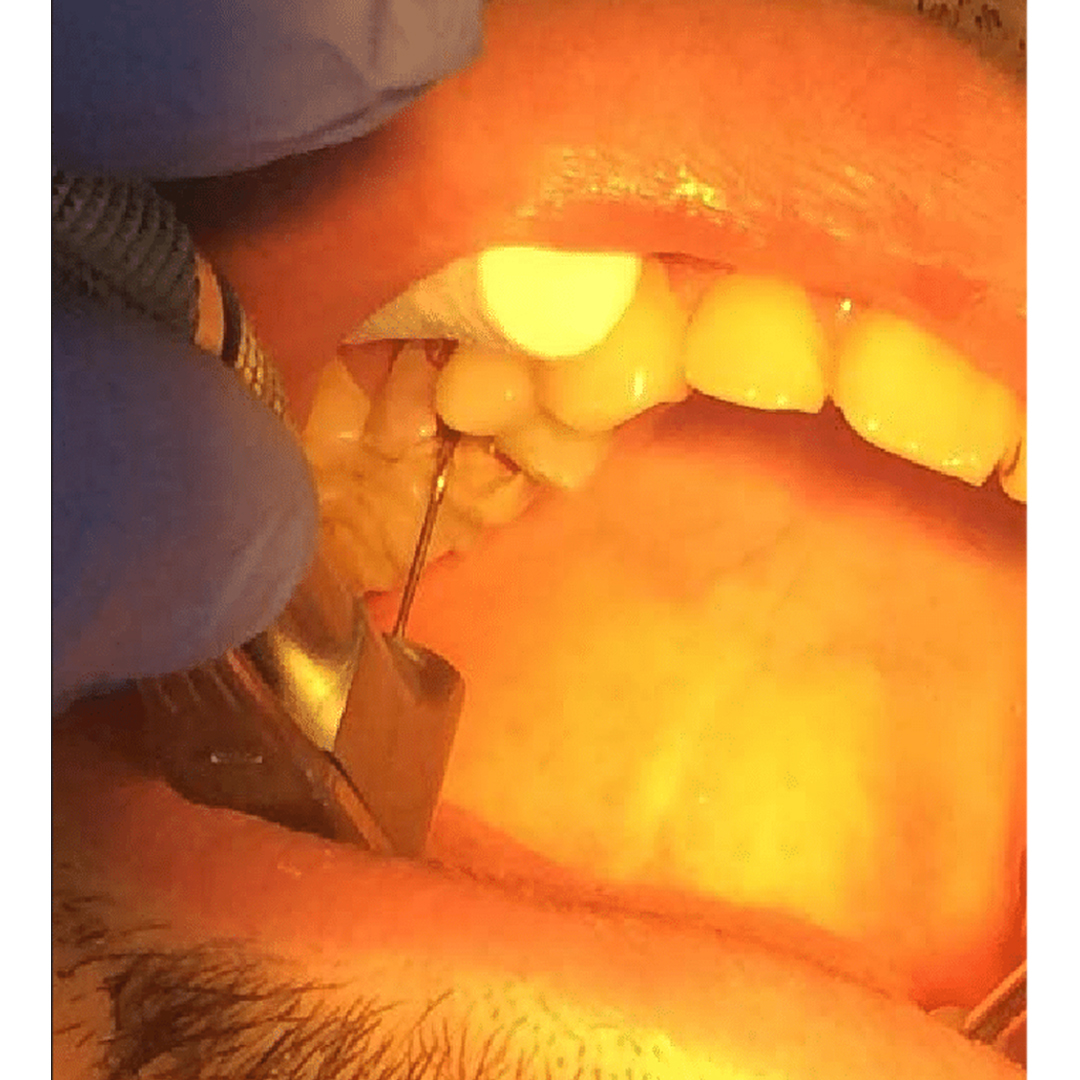 Mani Peeso Reamers Assorted 28mm #1-6