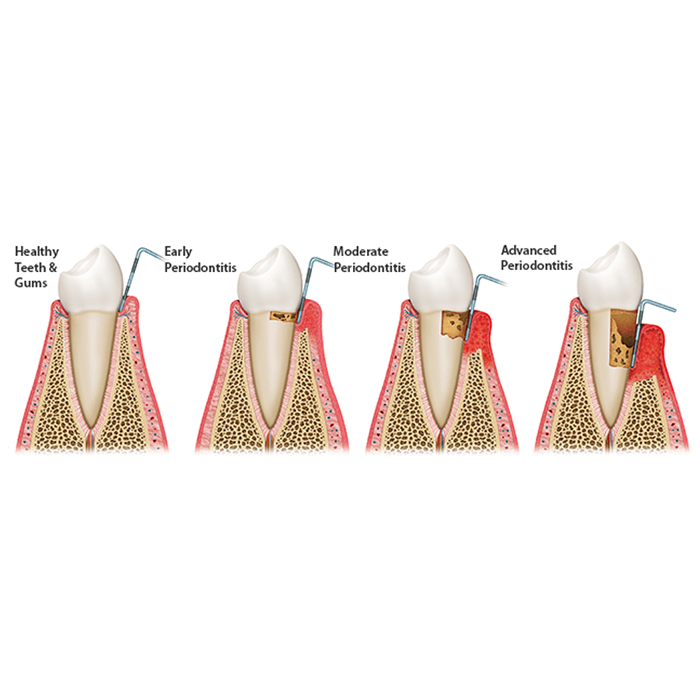 GDC Double End Probes Unc 15 / Screening Probe #6 (PCP15/11.5B)