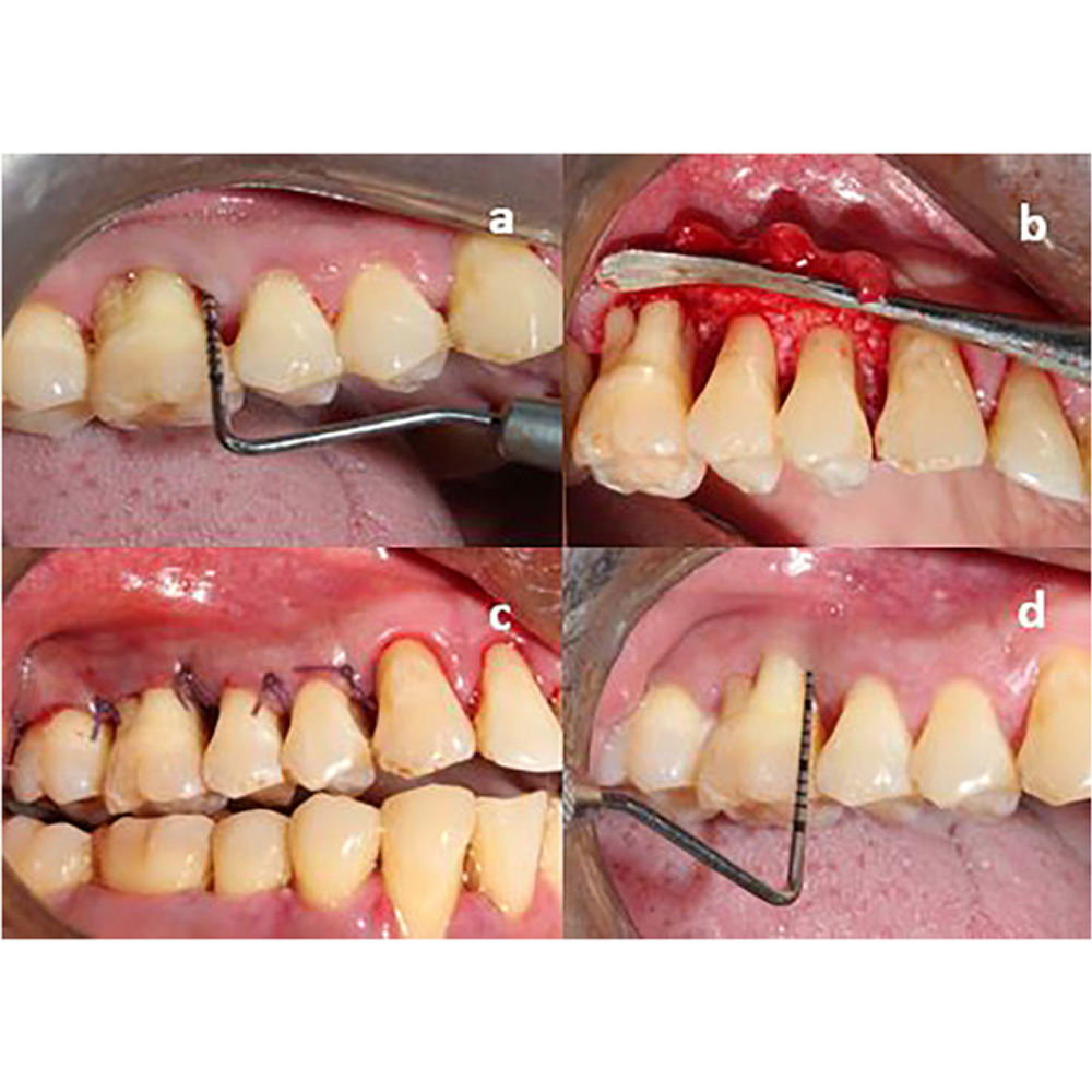 GDC Perio Surgical S/12 With Cassette (Psiwc12)