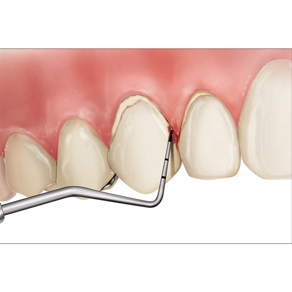 GDC Single End Probes Screening Probe (Who Probe) #6 (Pcp11.5b)
