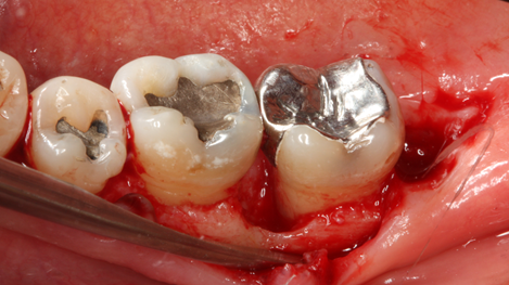 Waldent Oral Surgical Impaction Kit Set of 21 (K9/2) 