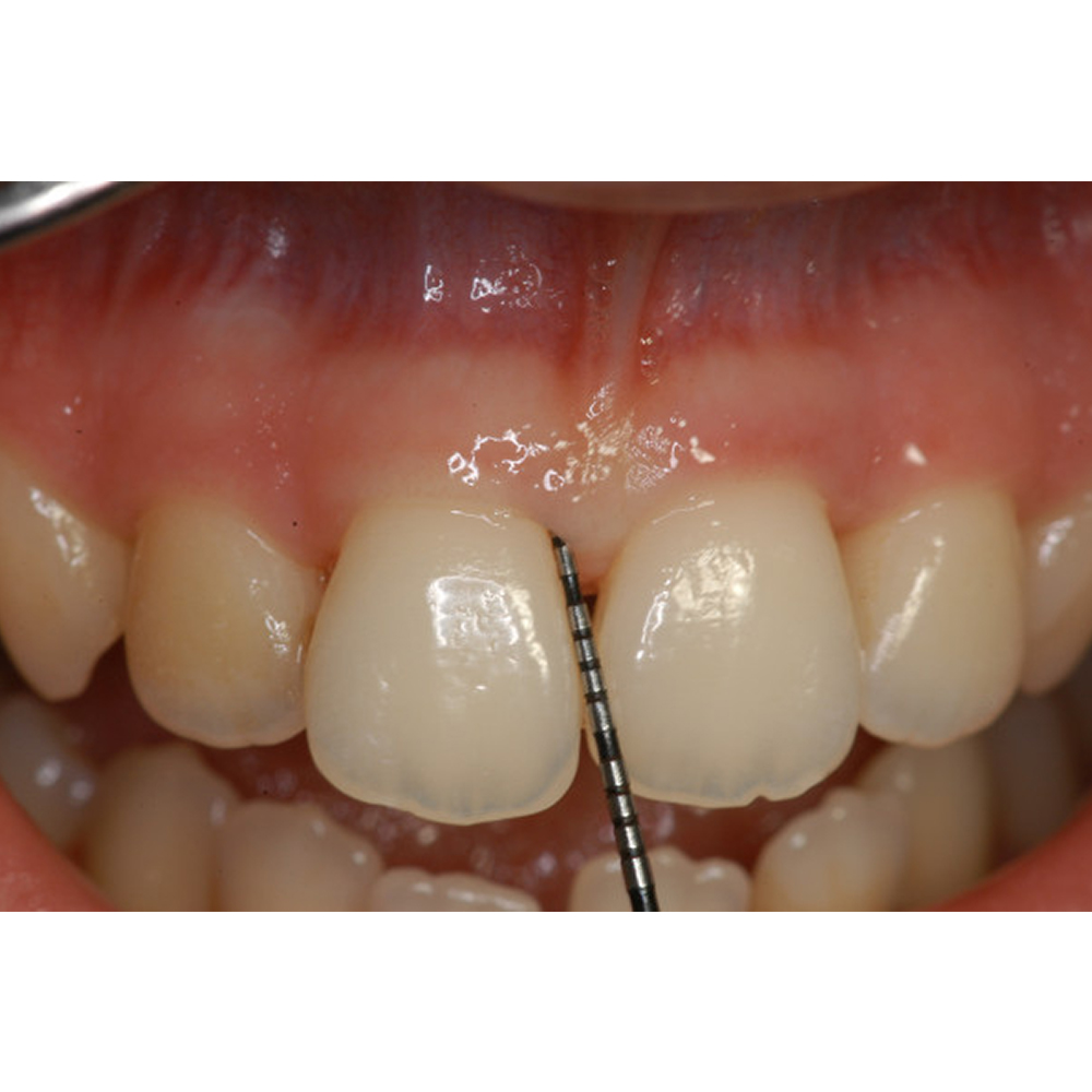 GDC Double End Probes Thin William / Screening Probe # 6 (Pcpqow/11.5b)