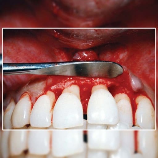 GDC Periosteal Elevator Molt-9 Large - 3 (P9)