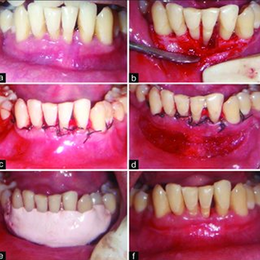 GDC Periosteal Elevator P149 - 6