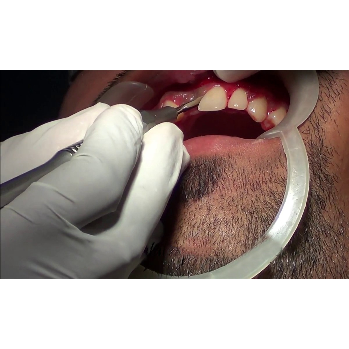 GDC Periotome Set Of 4 Hollow Handle 8mm # 4 (Pts4)