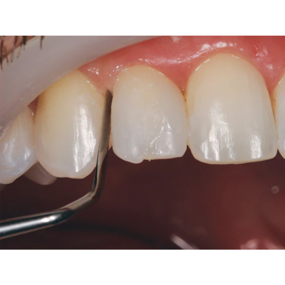 GDC Heidemann Spatula # 6 (PFIHS1)