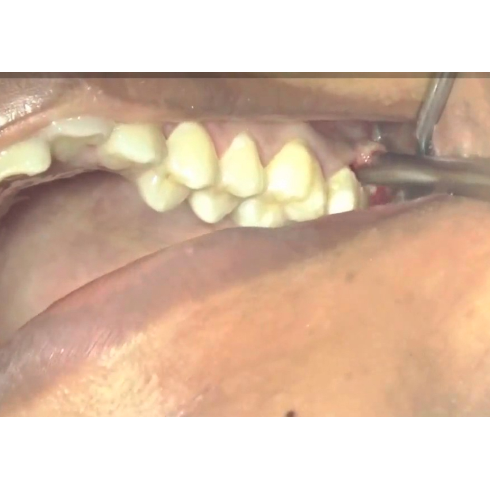 GDC Periosteal Elevator Howarth (Ph)