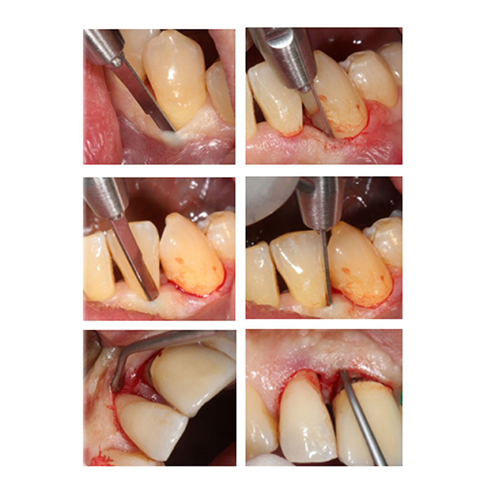 GDC Papila Elevator - 6 (PH26M)