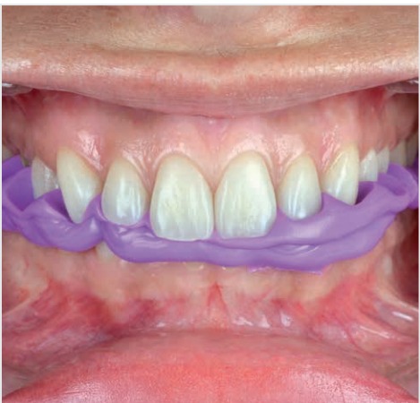 Zhermack Occlufast Rock Bite Registration Material C200726