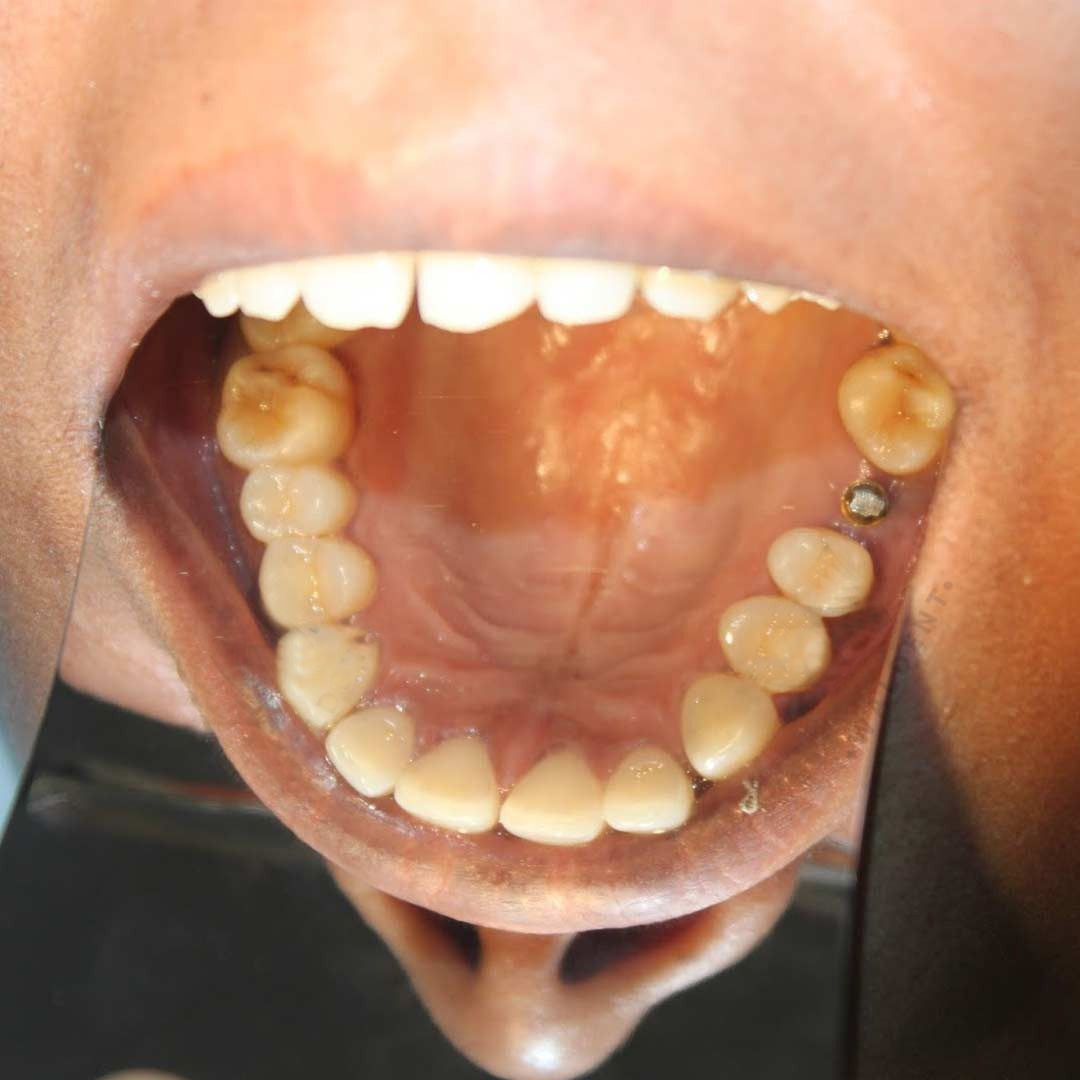 Sawbros Intraoral Photographic Mirrors