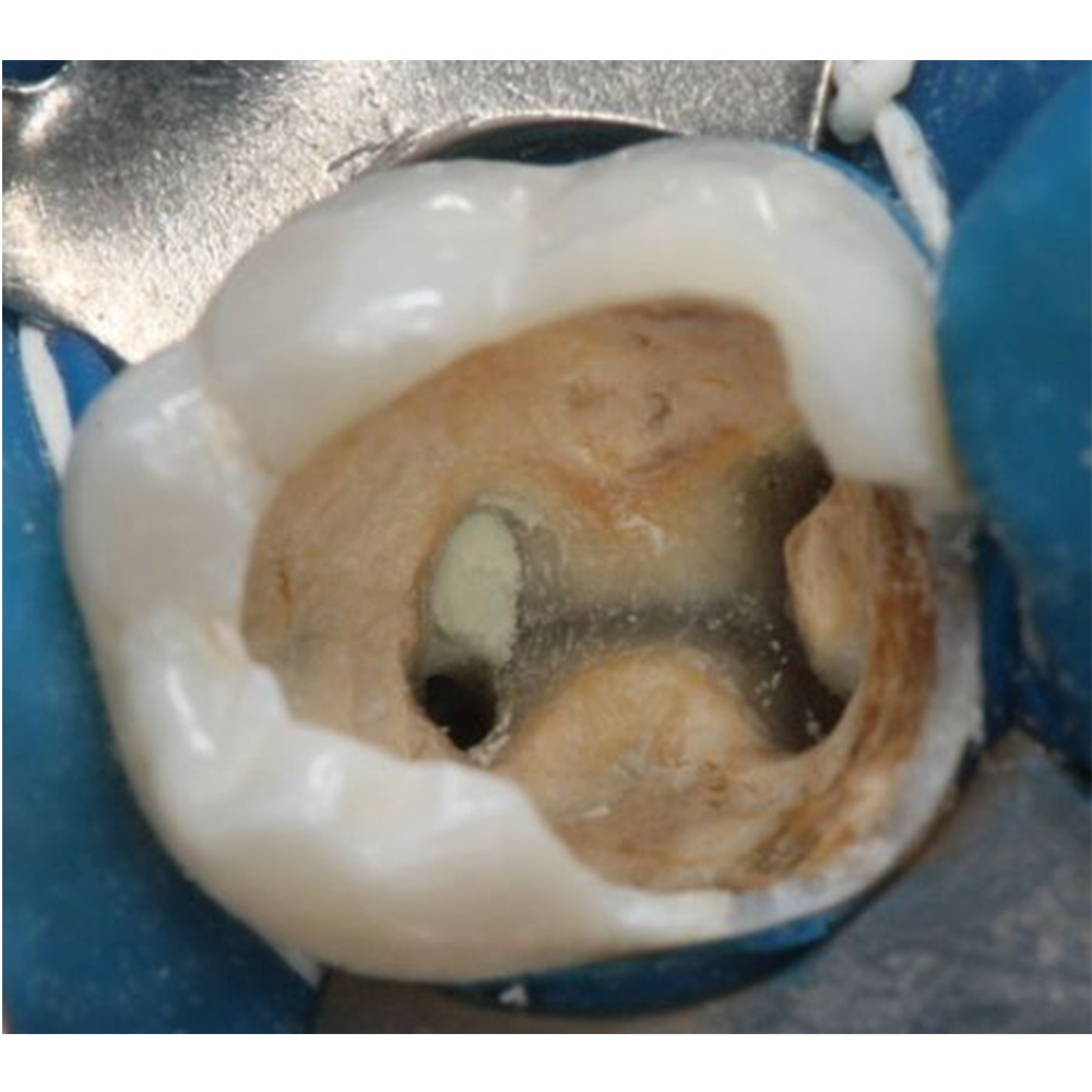 Angelus MTA 0.14gm (Single Application)