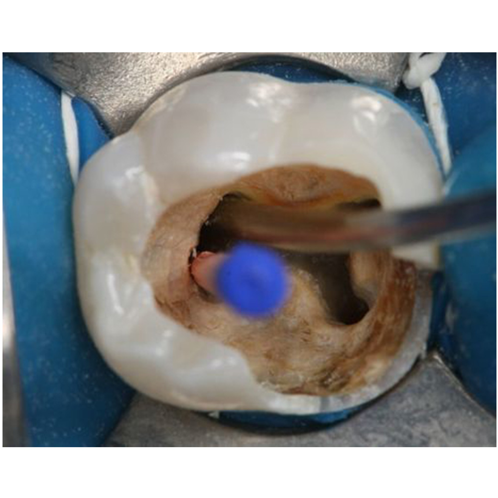 Angelus MTA 0.14gm (Single Application)