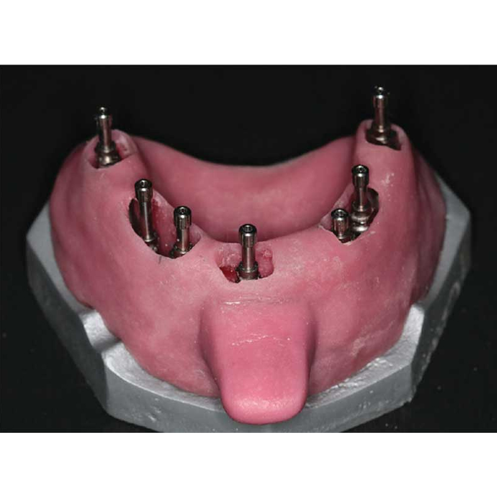 Xcem Conical Pick Up Impression Coping - Non Hex