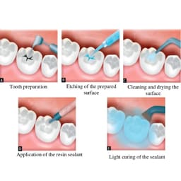 Kids-e-Pit and Fissure Sealant - 7