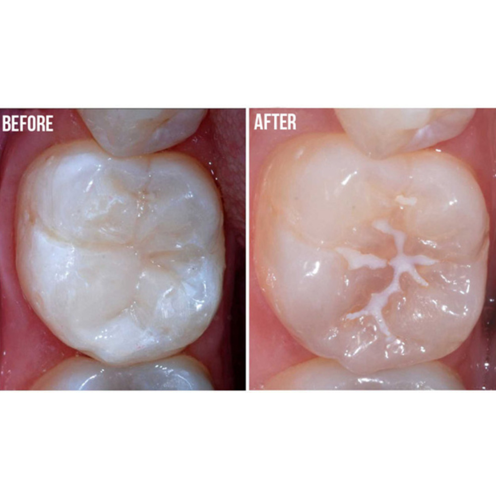 Kids-e-Pit and Fissure Sealant