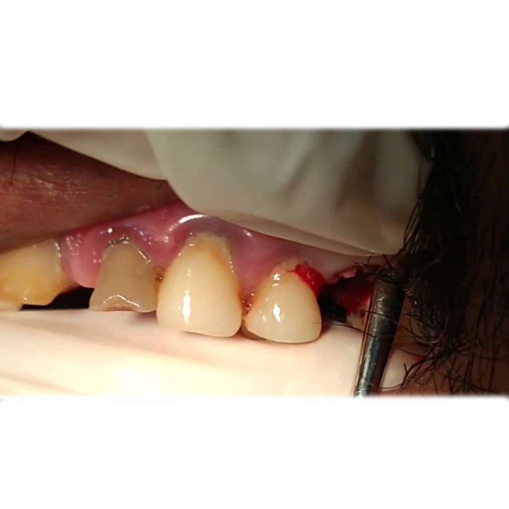 GDC Periosteal Elevator Kramer Naviens Solid Ring Handle (PKN1 #3)