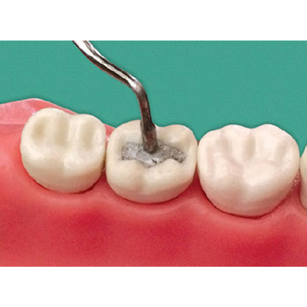 GDC Plugger/Condenser Non Serrated - #3 PLG1L