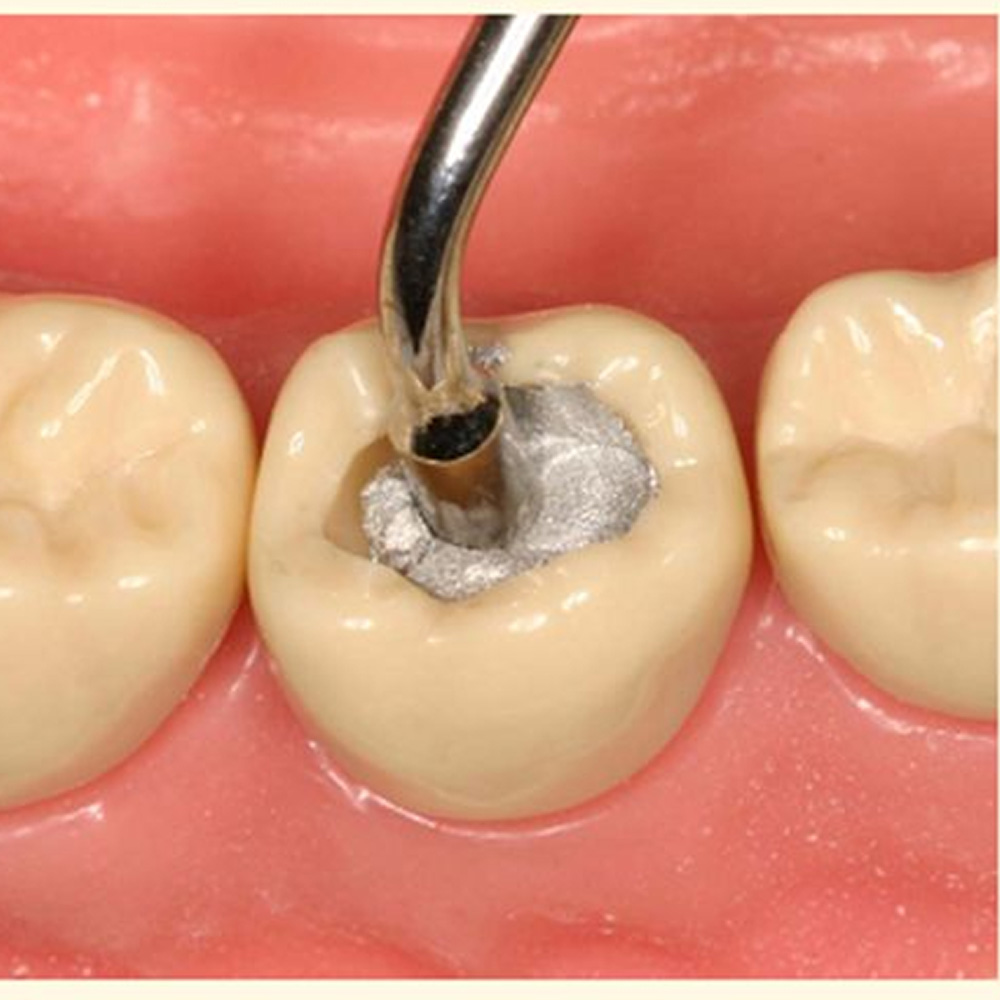 GDC Plugger/Condenser Serrated -#4 Plg1 