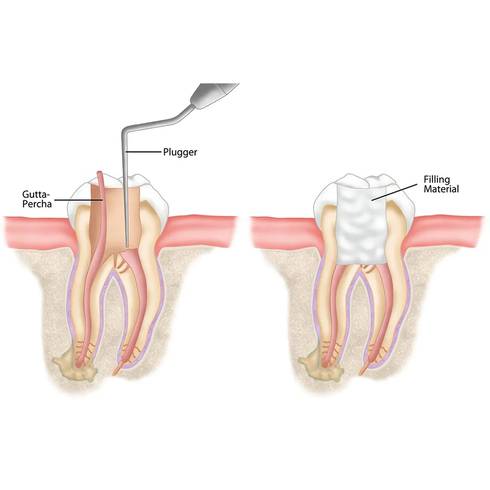 GDC Iso Sized Plugger -7 (.60mm) (Rcpcc60)