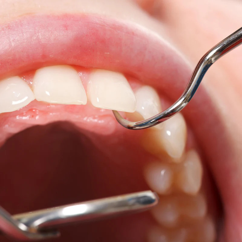 Dental Diagnostic Instruments (PMT)