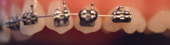 Phyx Thrust Metal Brackets