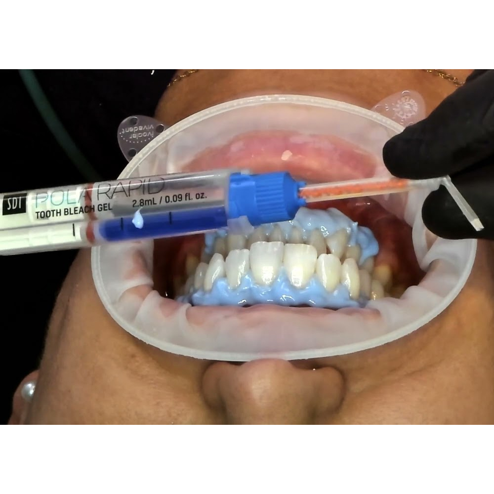 SDI Pola Rapid Advanced Tooth Whitening System