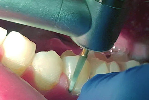 Eve Bracket Debonding Kit 9079