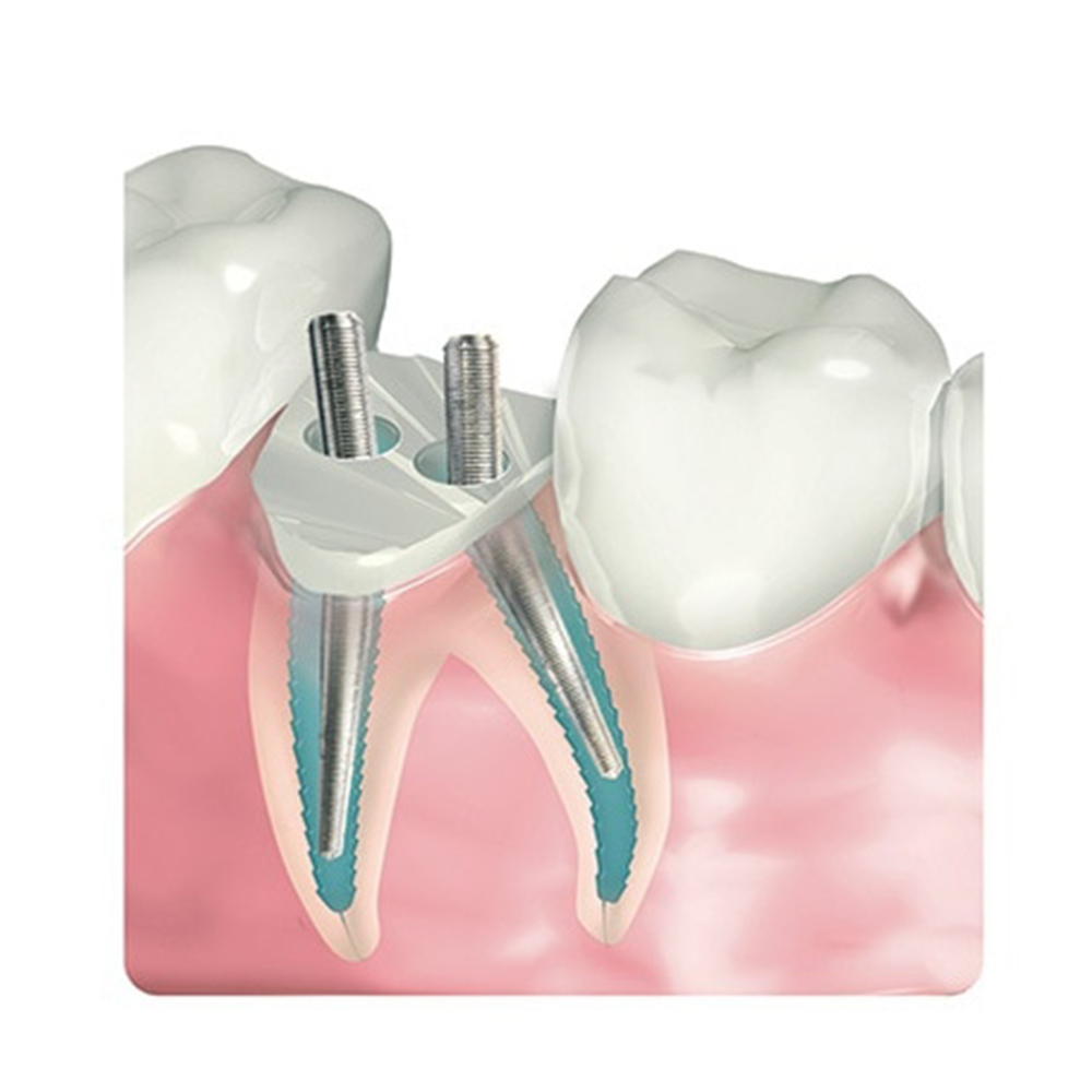 Filhol Dental Filpost Refill Packs