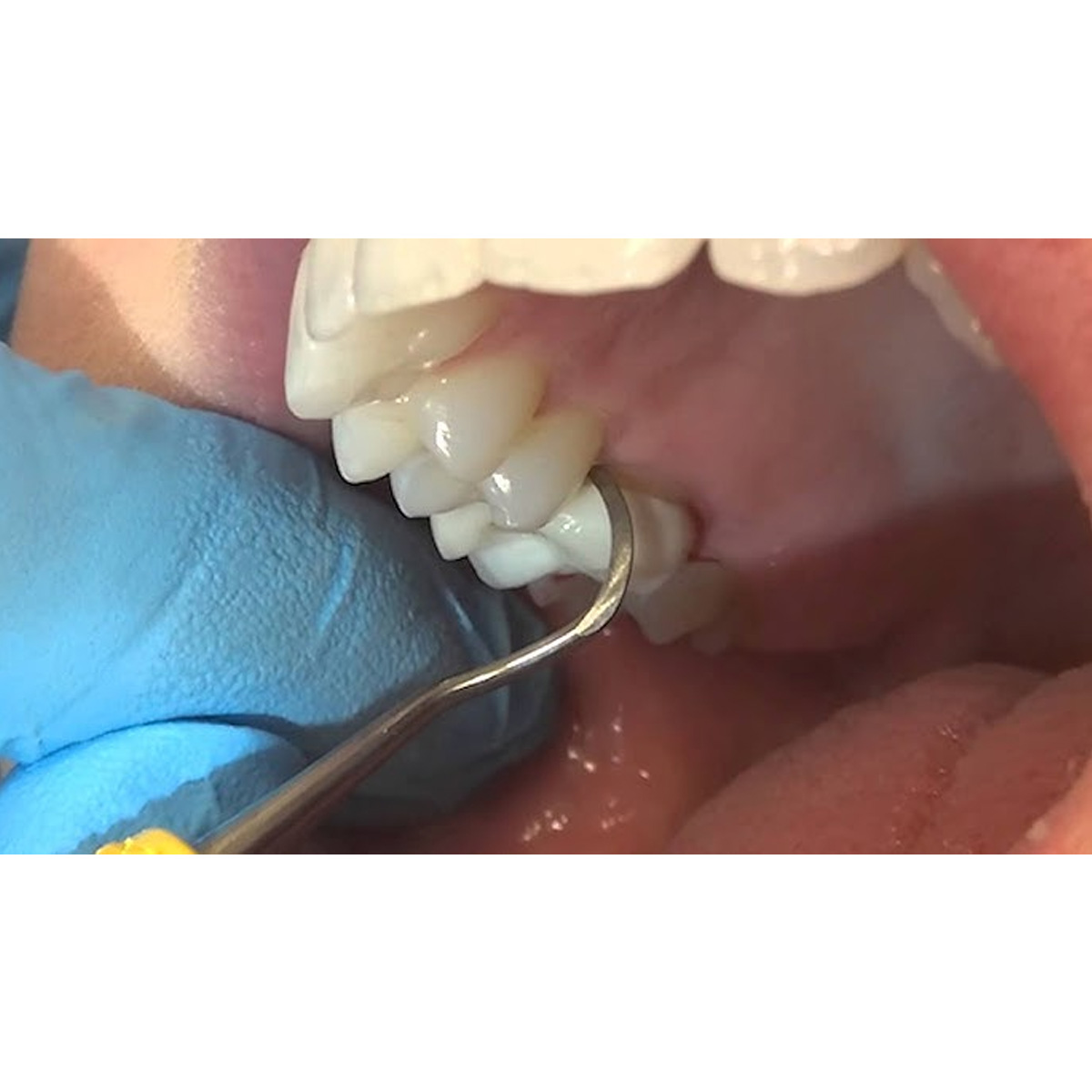 American Eagle Posterior Scaler Eagle Claw Red Resin Handle - AESECX